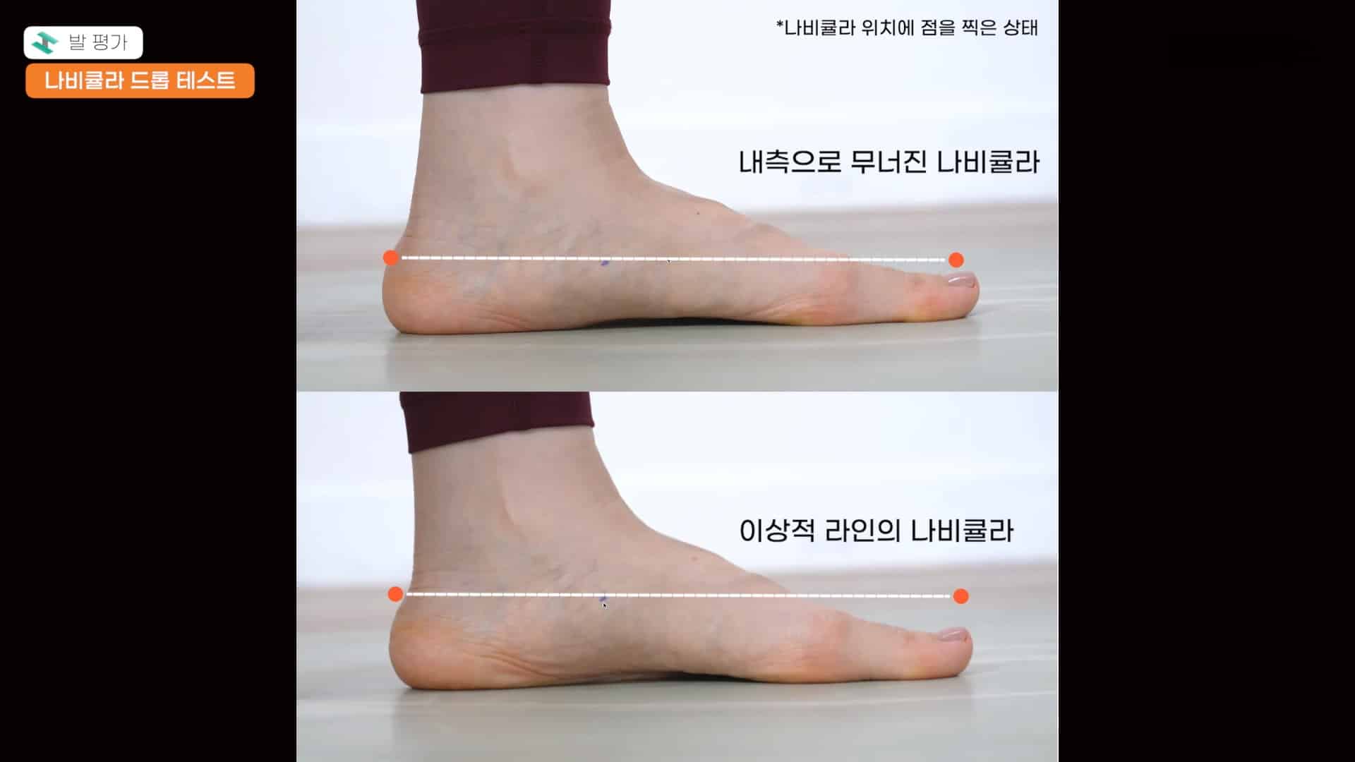 CASE 01 Before — 崩れた足アーチ