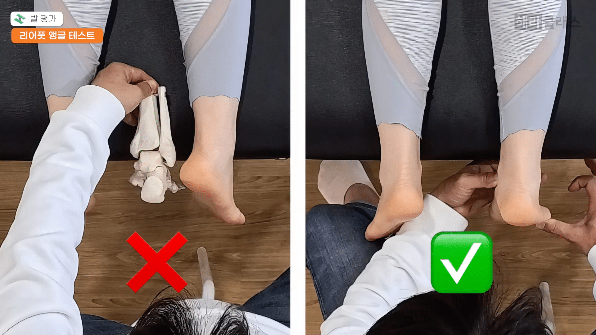 CASE 01 After — 足アーチ回復 + グルート活性化